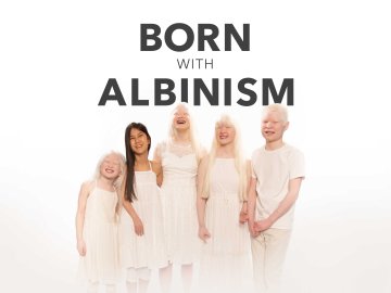 Born with Albinism