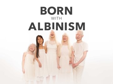 Born with Albinism